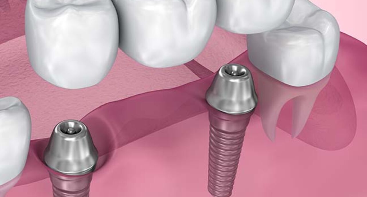 blog - Bullsmoor Dental & Aesthetics Clinic