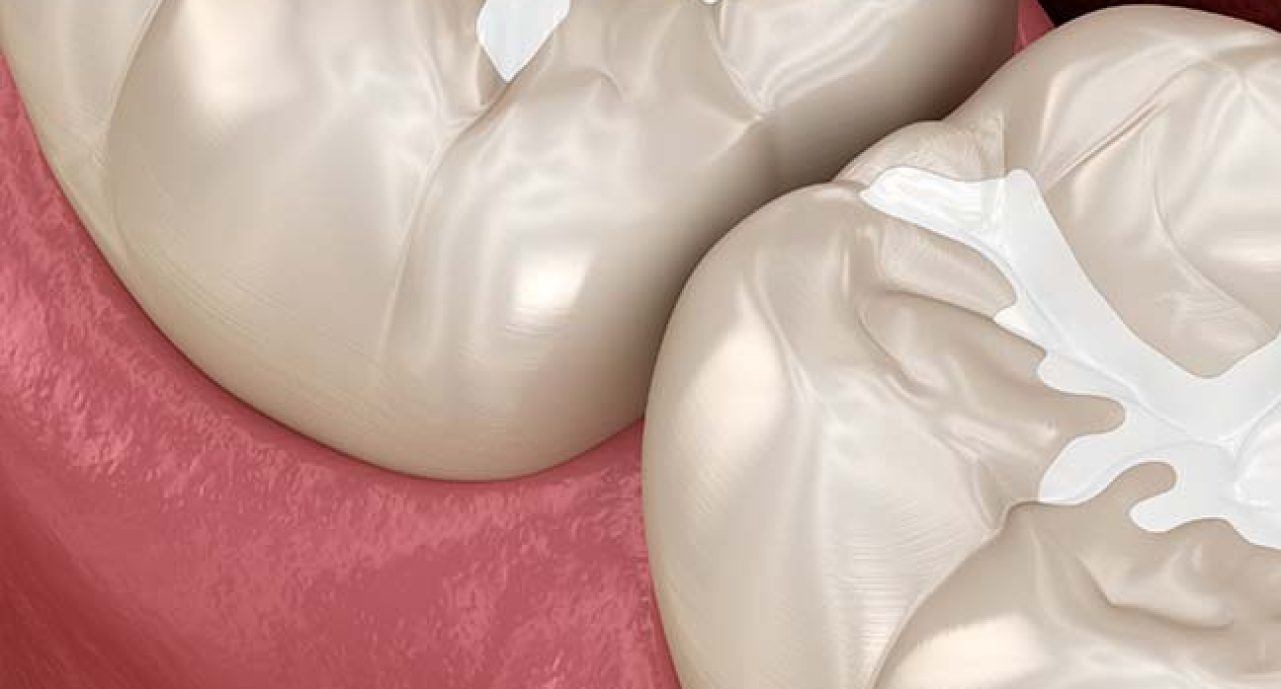 White Fillings