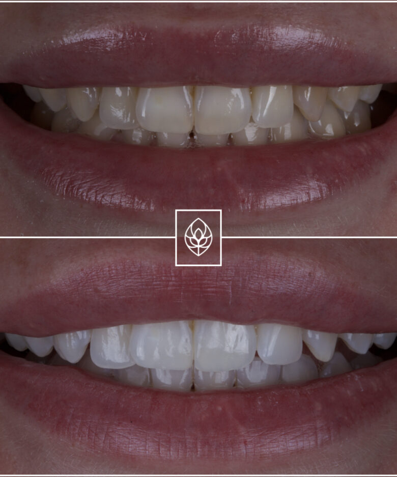 Before - Bullsmoor Dental