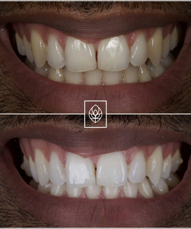 Before - Bullsmoor Dental