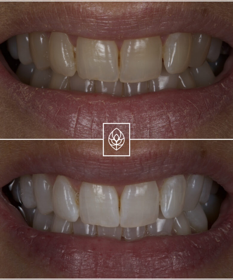 Before - Bullsmoor Dental