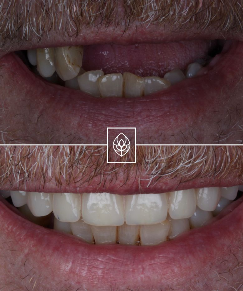 Before - Bullsmoor Dental