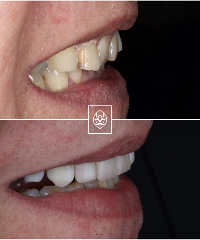 Before - Bullsmoor Dental