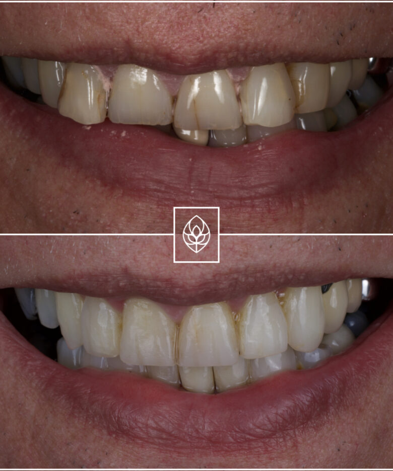 Before - Bullsmoor Dental
